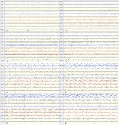 Ketogenic Diet as a Treatment for Super-Refractory Status Epilepticus in Febrile Infection-Related Epilepsy Syndrome